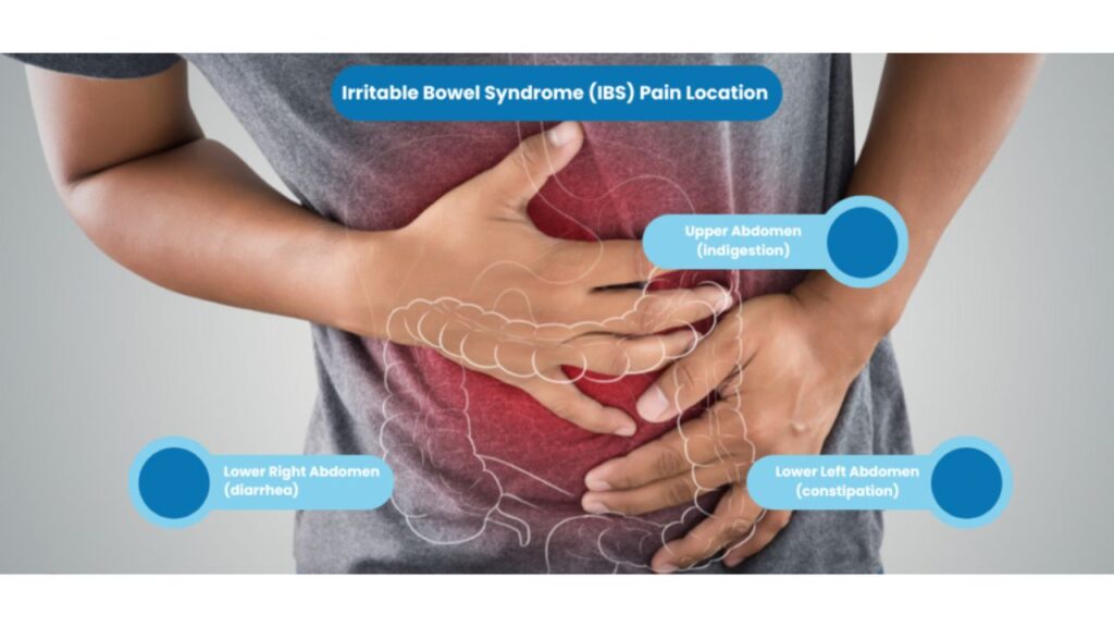 IBS Explained: Symptoms, Triggers and Everyday Management