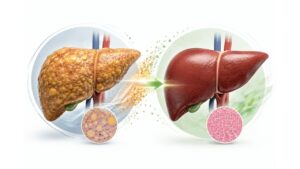 Can Fatty Liver Be Reversed? What the Evidence Says