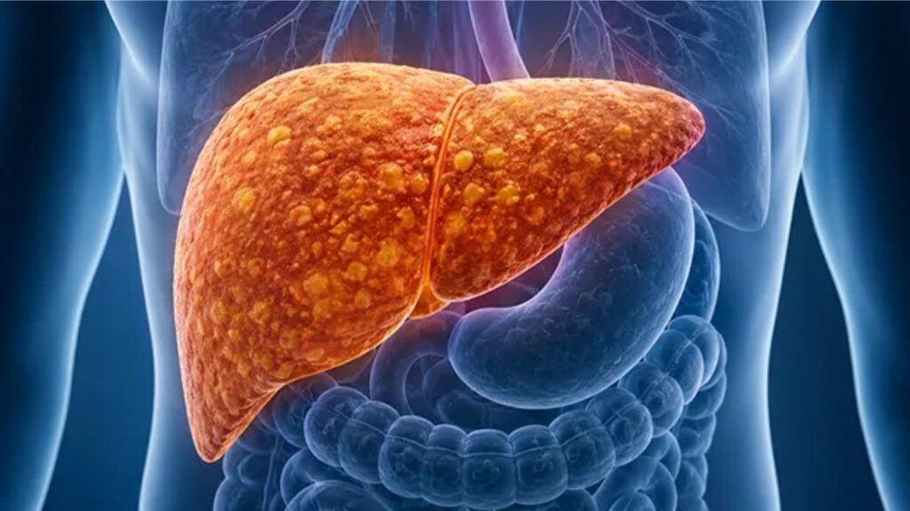 Fatty Liver Without the Jargon: MASLD Explained
